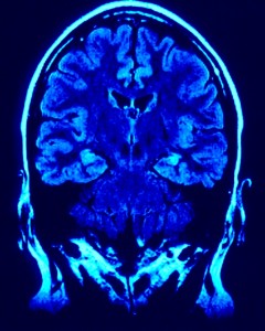 Cerveau IRM bleu